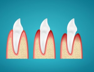 Stages progress disease gum on human canine on blue background