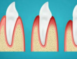 gum disease