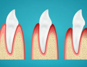 periodontitis